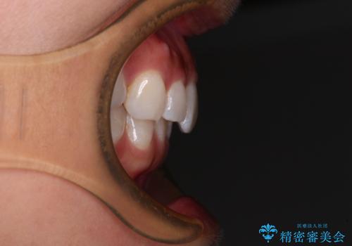 【モニター】前歯のデコボコと小さい前歯 インビザライン矯正とオールセラミッククラウン補綴治療の治療前