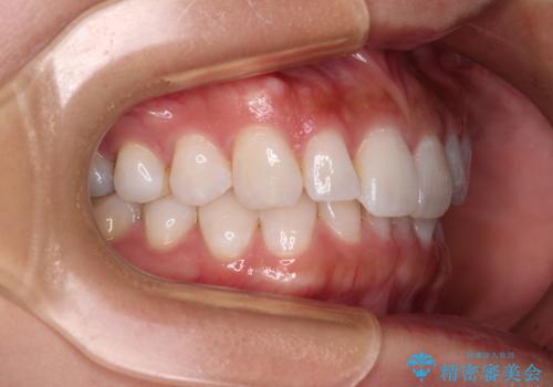 【モニター】前歯のデコボコと小さい前歯 インビザライン矯正とオールセラミッククラウン補綴治療の治療前