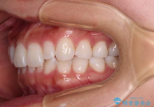 【モニター】前歯のデコボコと小さい前歯 インビザライン矯正とオールセラミッククラウン補綴治療の治療前