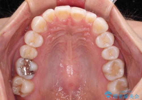 【モニター】前歯のデコボコと小さい前歯 インビザライン矯正とオールセラミッククラウン補綴治療の治療前