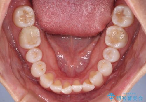 【モニター】前歯のデコボコと小さい前歯 インビザライン矯正とオールセラミッククラウン補綴治療の治療前