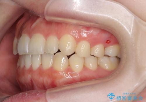 八重歯 歯を抜かずにマウスピース矯正で インプラント矯正で上の奥歯を後ろに移動の治療後
