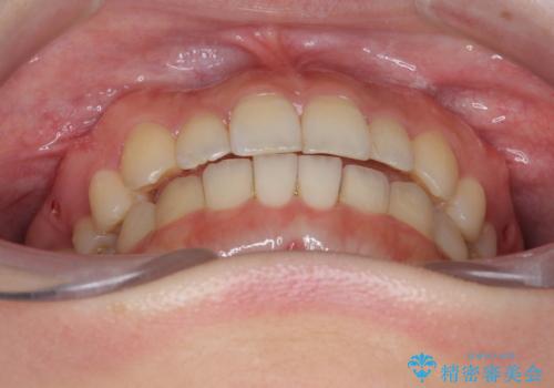 八重歯 歯を抜かずにマウスピース矯正で インプラント矯正で上の奥歯を後ろに移動の治療後