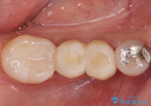 歯槽堤保存術 → インプラント治療の症例 治療後