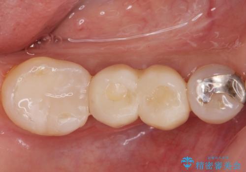 歯槽堤保存術 → インプラント治療の治療後