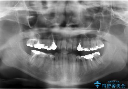 歯並びと虫歯(メタルフリー)を行った全顎治療の治療前