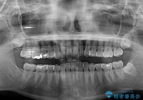 【モニター】前歯のデコボコと小さい前歯 インビザライン矯正とオールセラミッククラウン補綴治療の治療前