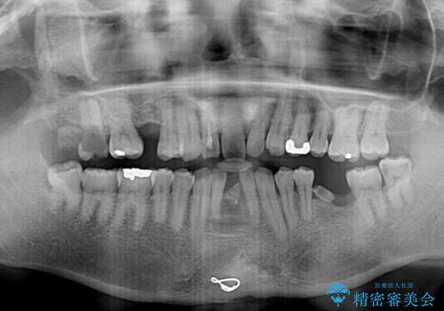 放置した歯列　矯正治療とインプラント治療で劇的に改善の治療前