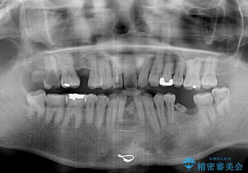 放置した歯列 矯正治療とインプラント治療で劇的に改善の治療前