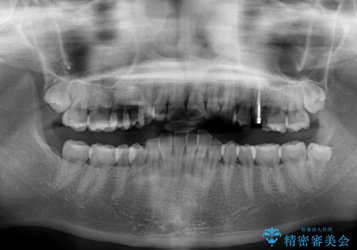 インビザラインが続けられない ワイヤー矯正に切り替えてデコボコを改善の治療前