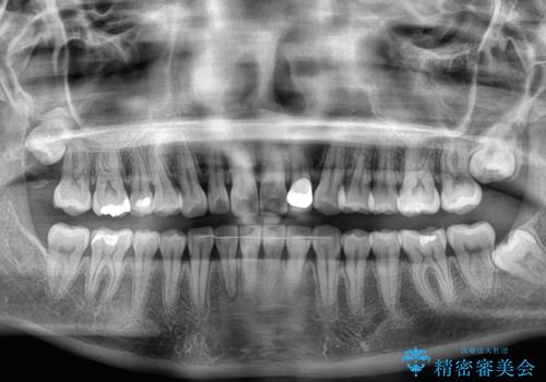 【モニター】前歯のデコボコと小さい前歯 インビザライン矯正とオールセラミッククラウン補綴治療の治療後