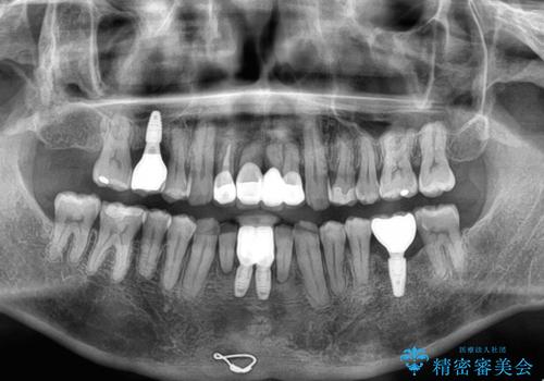放置した歯列　矯正治療とインプラント治療で劇的に改善の治療後