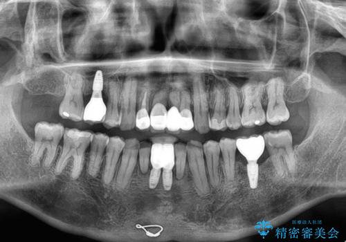 放置した歯列 矯正治療とインプラント治療で劇的に改善の治療後