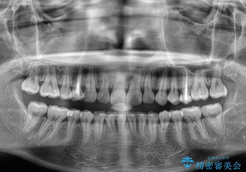 インビザラインが続けられない　ワイヤー矯正に切り替えてデコボコを改善の治療後