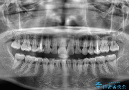 インビザラインが続けられない ワイヤー矯正に切り替えてデコボコを改善の治療後