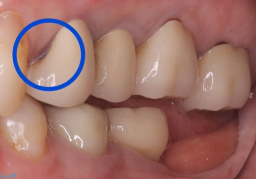 【セラミッククラウン】昔入れた被せものの黒いところが気になるの治療前
