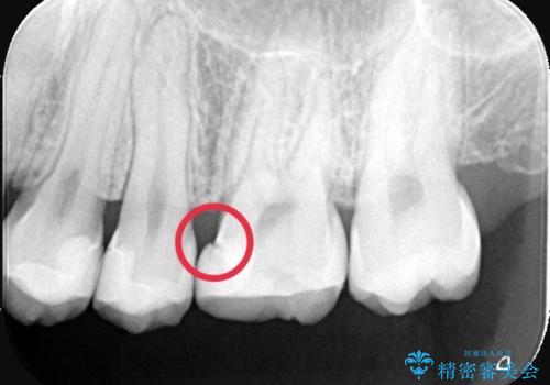 【セラミックインレー】歯が黒くなっているの治療前