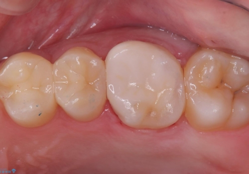 【セラミックインレー】歯が黒くなっているの治療後