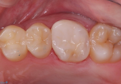 【セラミックインレー】歯が黒くなっているの症例 治療後
