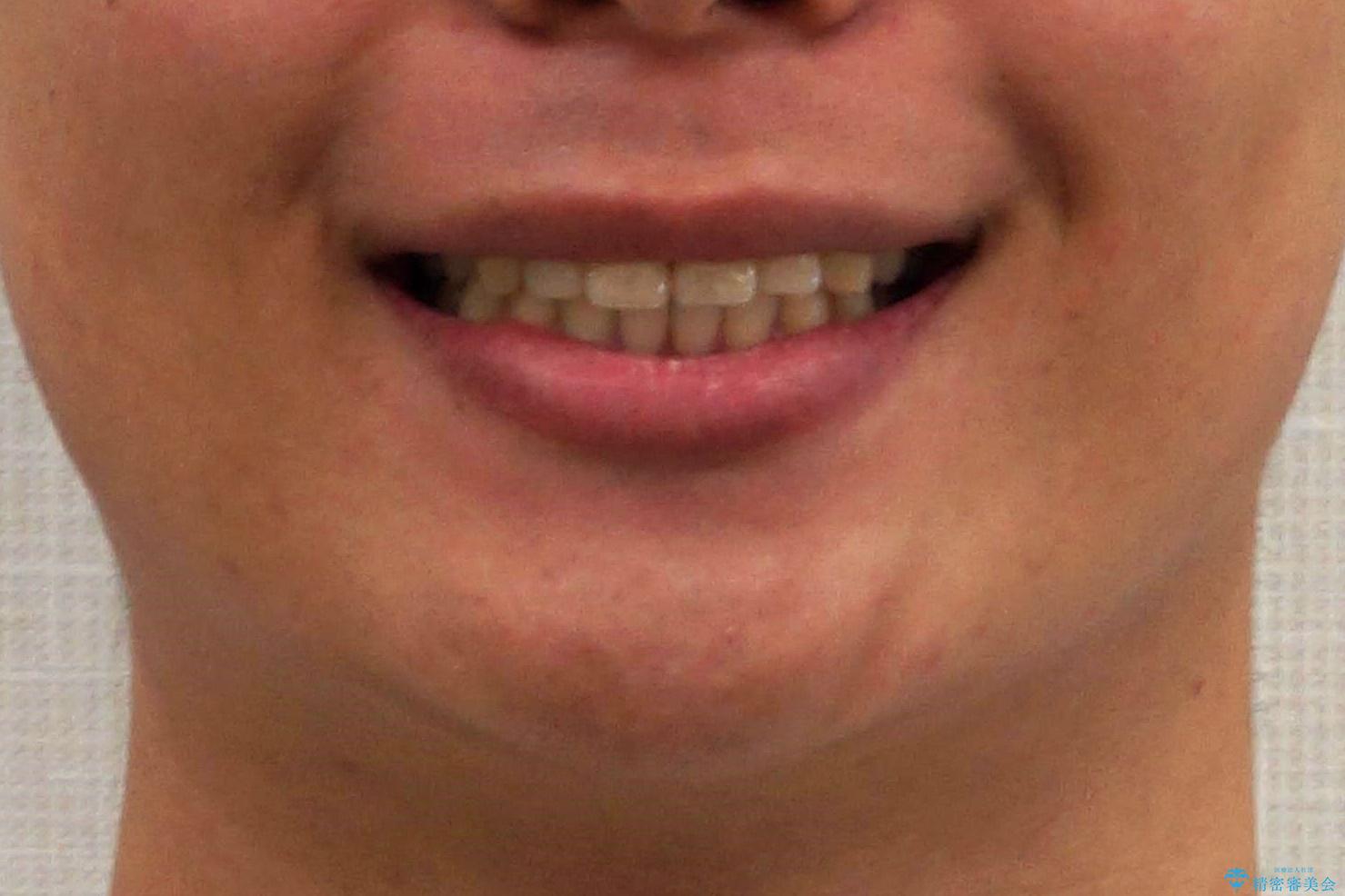 抜歯矯正の長期予後(術後8年目)の治療後(顔貌)