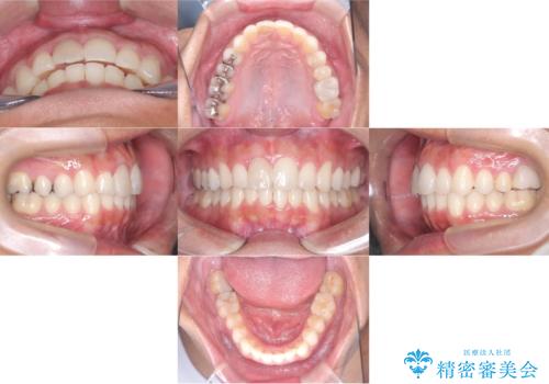 【インビザライン　非抜歯】歯の捻じれと歯のでこぼこを治したい!の治療後