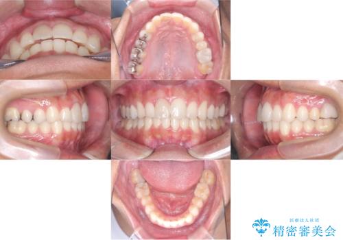 【インビザライン 非抜歯】歯の捻じれと歯のでこぼこを治したい!の治療後