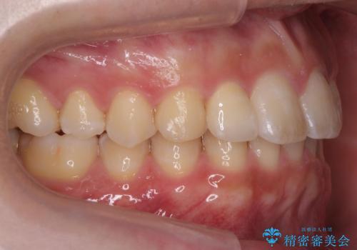 前歯のすき間 小さい歯がある 前歯の並びをきれいにしたいの治療後