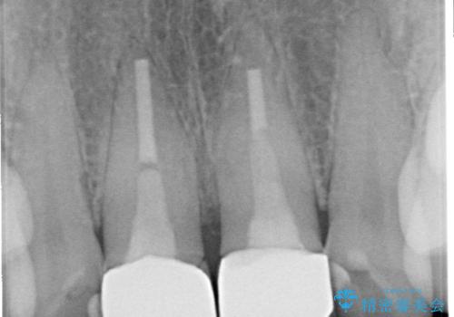 前歯の黄色味が気になる オールセラミッククラウン(スペシャル)の治療後
