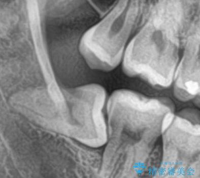 親知らず抜歯の症例 治療前