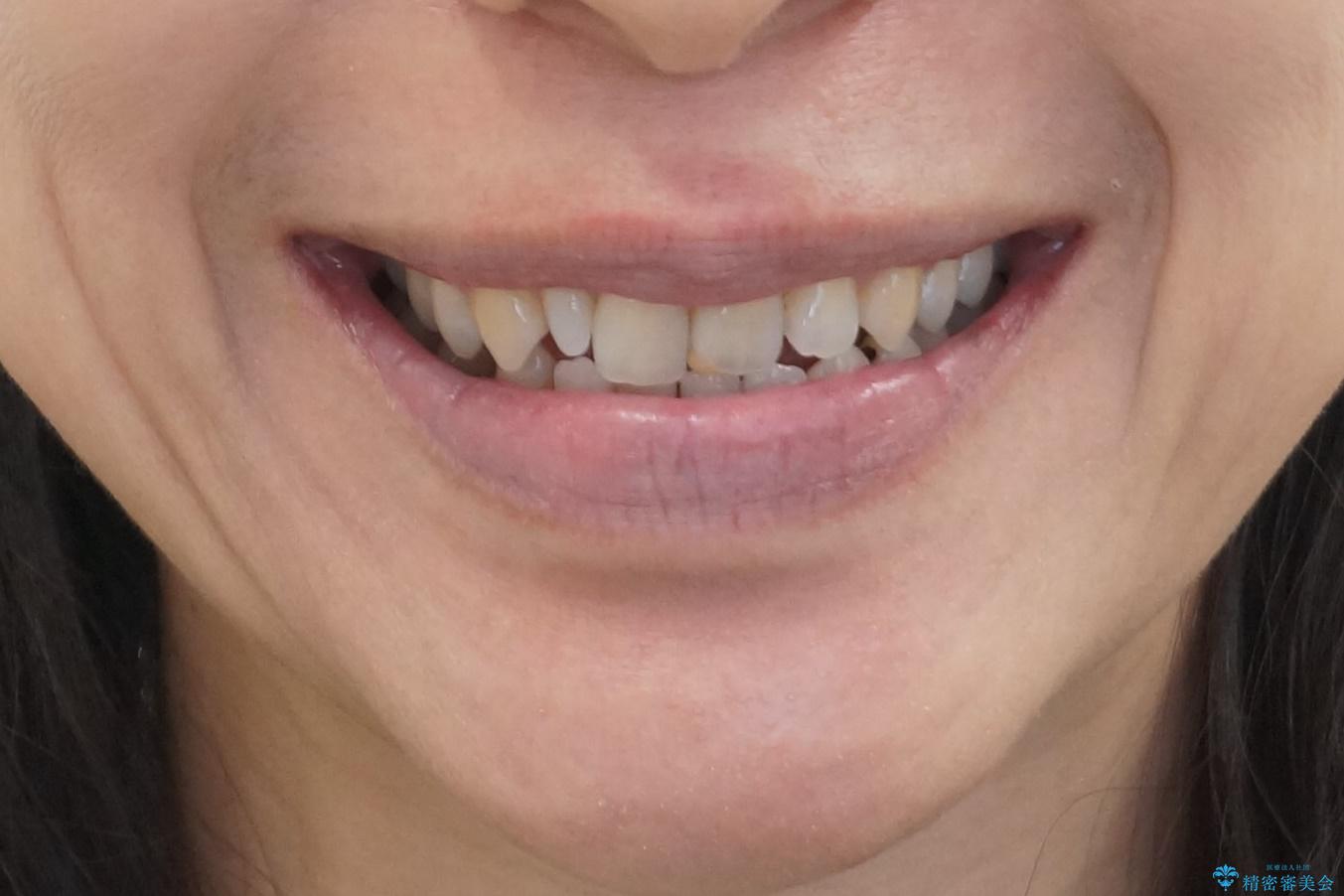 矮小(わいしょう)歯の形をセラミックで自然に 50代女性の治療前(顔貌)