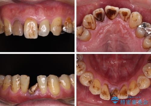 放置した歯列　矯正治療とインプラント治療で劇的に改善の治療前