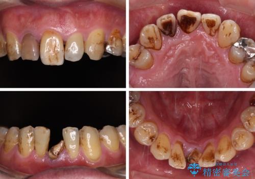 放置した歯列 矯正治療とインプラント治療で劇的に改善の治療前