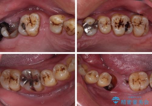 放置した歯列 矯正治療とインプラント治療で劇的に改善の治療前