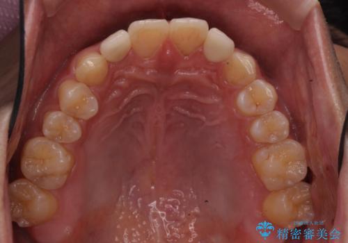 前歯のすき間　小さい歯がある　前歯の並びをきれいにしたいの治療後