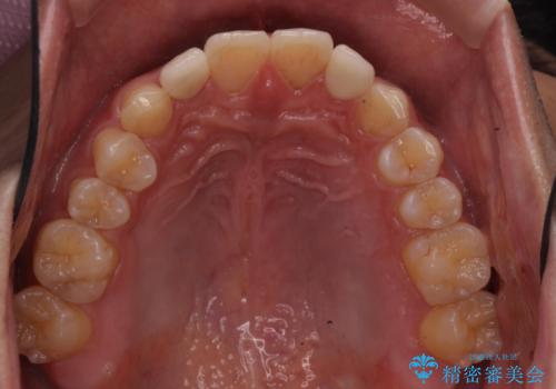 前歯のすき間 小さい歯がある 前歯の並びをきれいにしたいの治療後