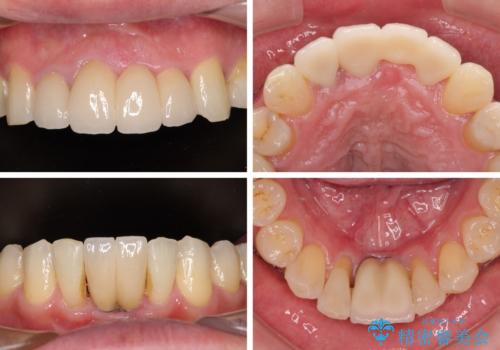 放置した歯列　矯正治療とインプラント治療で劇的に改善の治療後