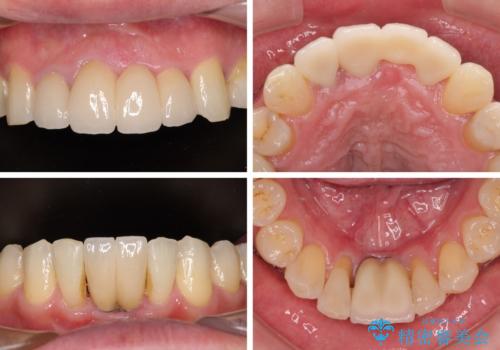 放置した歯列 矯正治療とインプラント治療で劇的に改善の治療後
