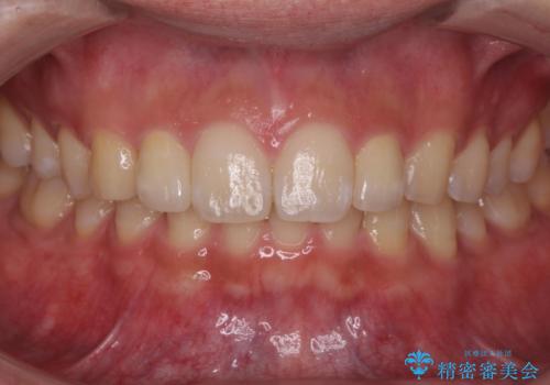 前歯のすき間 小さい歯がある 前歯の並びをきれいにしたいの症例 治療後