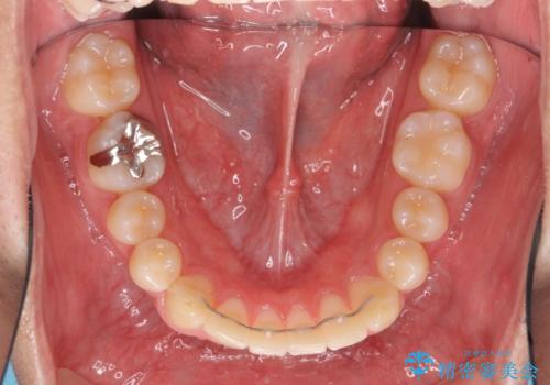 抜歯矯正の長期予後(術後8年目)の治療中