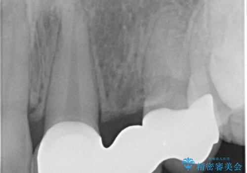前歯の審美的なブリッジ (歯列矯正後)の治療後