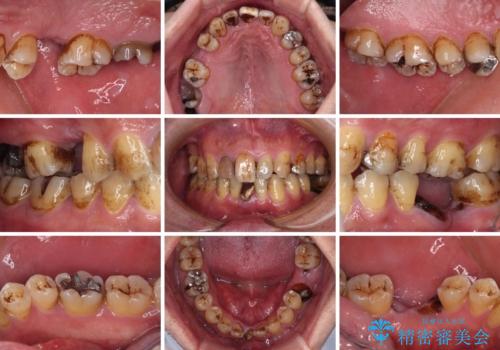 放置した歯列　矯正治療とインプラント治療で劇的に改善の治療前