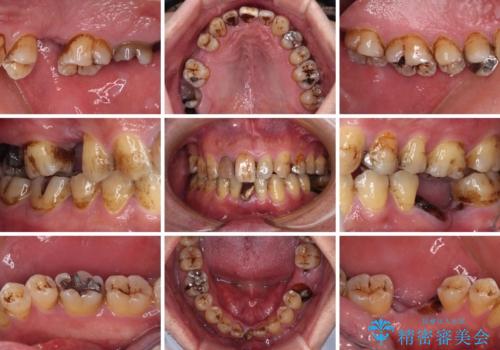放置した歯列 矯正治療とインプラント治療で劇的に改善の治療前