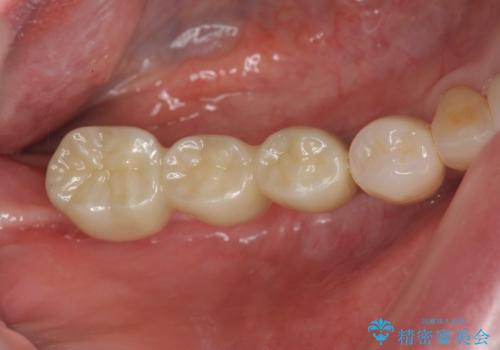 歯周病で失った歯をインプラント治療で咬合機能回復の治療後