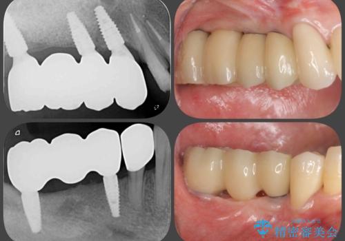 歯周病で失った歯をインプラント治療で咬合機能回復