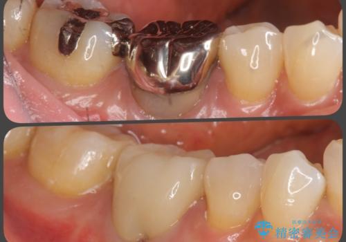 目立つ銀歯を除去したい メタルフリー治療の希望