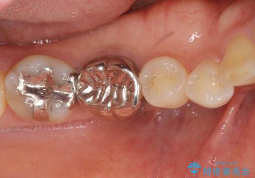 目立つ銀歯を除去したい メタルフリー治療の希望の治療前