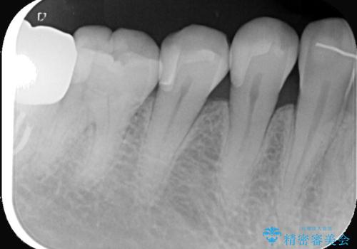 セラミックインレーによる虫歯治療の治療後