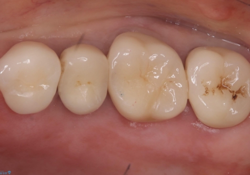 【セラミッククラウン】昔入れた被せものの黒いところが気になるの治療後