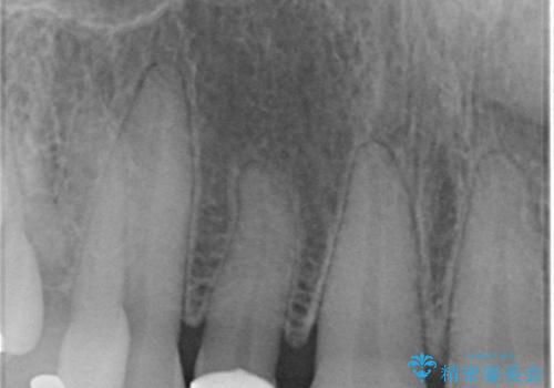 矮小(わいしょう)歯の形をセラミックで自然に 50代女性の治療後