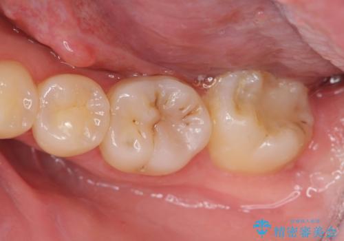 歯冠長延長術をおこなったアプローチの難しい虫歯治療の治療中